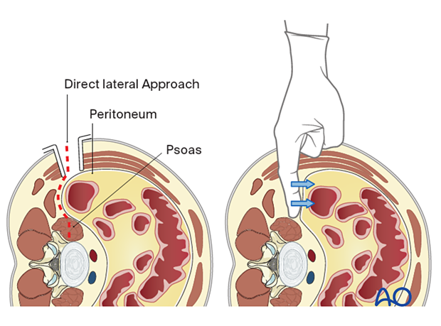 Detaching the psoas muscle from the peritoneum during a minimally invasive transpsoas approach