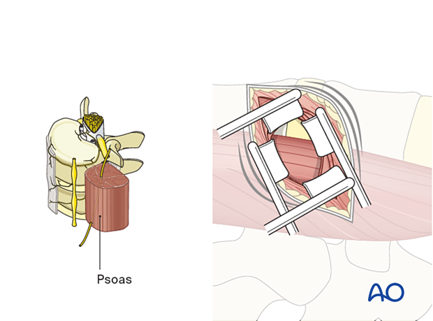 The psoas muscle is exposed during a minimally invasive transpsoas approach.