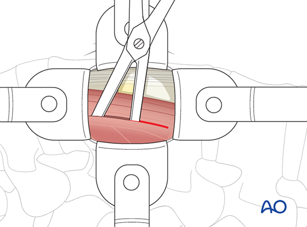 The psoas muscle is gently split during the minimally invasive transpsoas approach.
