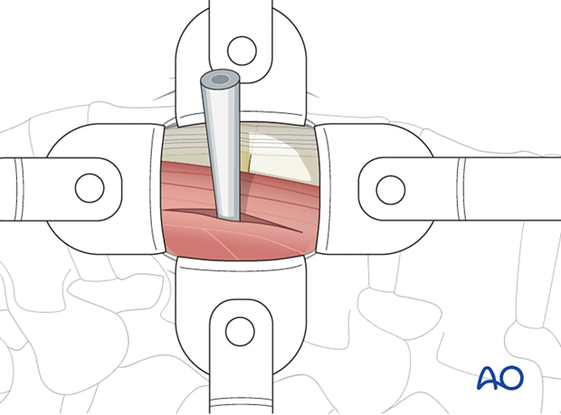 A tubular localizer is positioned through the muscle over the edge of the disc space during the minimally invasive transpsoas approach.