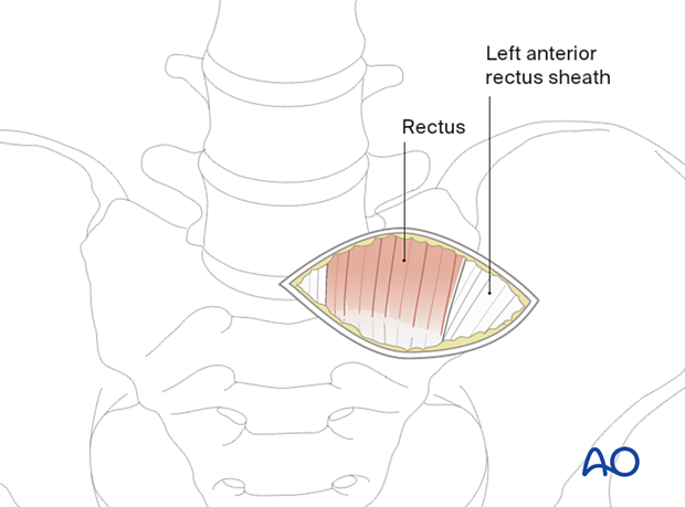 Mobilizing the skin and soft tissues of the left anterior rectus sheath during the Retroperitoneal approach for Anterior lumbar interbody fusion (ALIF)