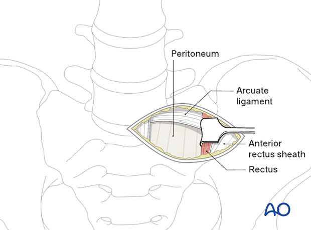 Mobilizing the intrafascial rectus muscle laterally to expose the underlying arcuate line during the Retroperitoneal approach for Anterior lumbar interbody fusion (ALIF).