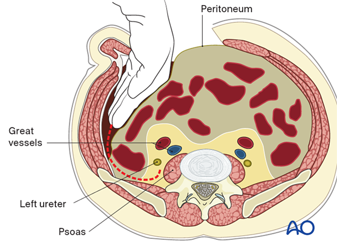 Retroperitoneal approach for Anterior lumbar interbody fusion (ALIF)