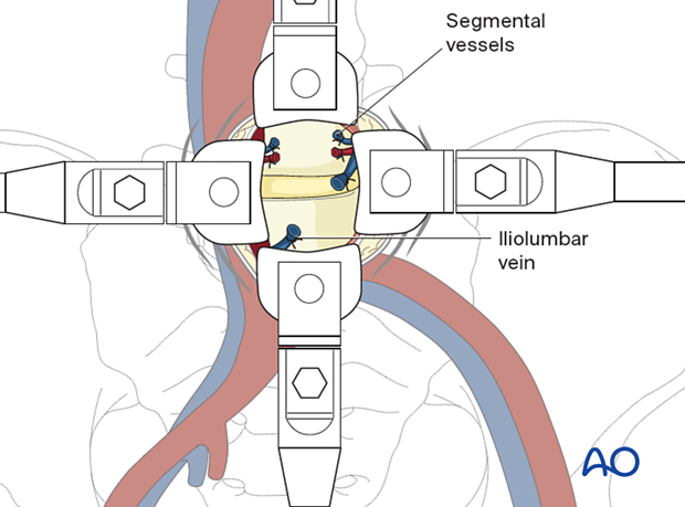 At the level of L4–L5 the aorta and vena cava are retracted to the right and segmental arteries and veins must be ligated during the Retroperitoneal approach for Anterior lumbar interbody fusion (ALIF).