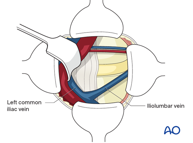 The iliolumbar vein is ligated to avoid a source of uncontrolled bleeding during the Retroperitoneal approach for Anterior lumbar interbody fusion (ALIF).