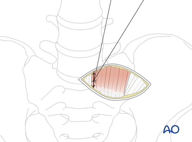 57b A720 Retroperitoneal approach for ALIF