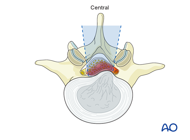 Central lumbar disc herniation
