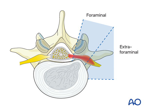 Lumbar disc herniation – foraminal and extraforaminal