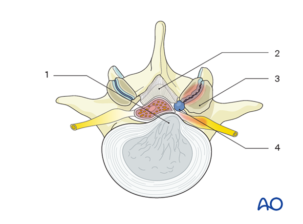 Degenerative etiologies are the most common cause of lumbar spinal stenosis. These include 1. Disc herniation, 2. Ligamentum flavum hypertrophy, 3. Facet arthropathy, 4. Synovial cyst.