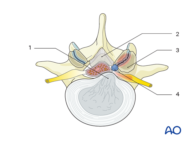 icd 10 degenerative lumbar spinal stenosis