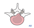 Central and posterolateral lumbar disc herniations