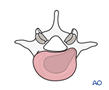 Foraminal and extraforaminal lumbar disc herniations