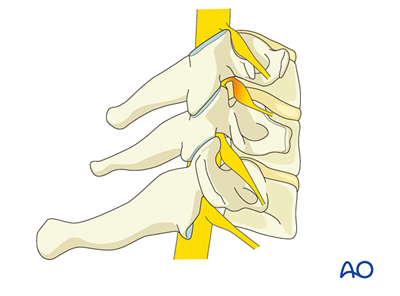 Posterior microscopic tubular cervical foraminotomy (PMTCF) for ...