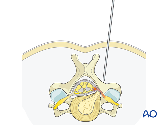 Posterior microscopic tubular cervical foraminotomy (PMTCF) for ...