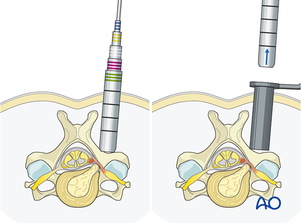 Insertion of sequential dilators and tubular retractor during Posterior microscopic tubular cervical foraminotomy (PMTCF).