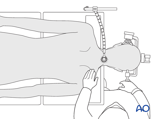 Securing the retractor to the table-mounted arm during Posterior microscopic tubular cervical foraminotomy (PMTCF).