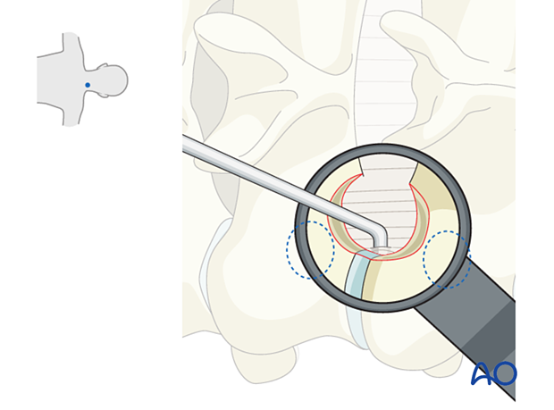 Dissecting the lateral aspect of the ligamentum flavum using a blunt nerve hook during Posterior microscopic tubular cervical foraminotomy (PMTCF).