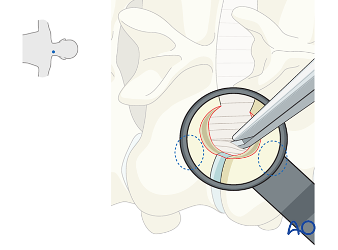 Posterior Microscopic Tubular Cervical Foraminotomy Pmtcf For Cervical Disc Herniation 5498