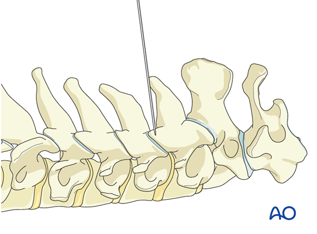 A spinal needle and AP and lateral fluoroscopy or navigation is used to identify the correct operative level during posterior cervical foraminotomy.