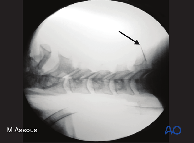 3D navigation can be used to localize the correct level during posterior cervical foraminotomy.