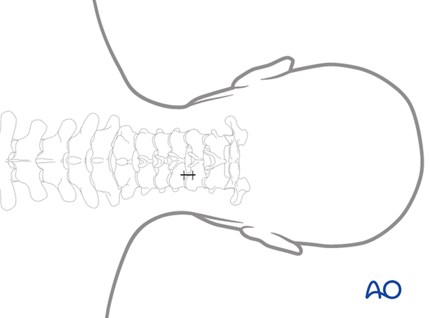 Wound closure during posterior cervical foraminotomy.