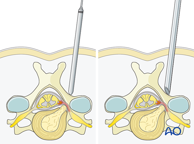 Inserting dilators and inserting the working channel with the bevel facing medially during Posterior endoscopic cervical foraminotomy (PECF).
