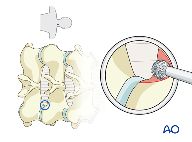Using a diamond burr, the inferior edge of the cranial lamina is drilled along the attachment of the ligamentum flavum during Posterior endoscopic cervical foraminotomy (PECF).