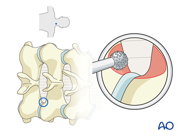Drilling the superior edge of the caudal lamina during Posterior endoscopic cervical foraminotomy (PECF).