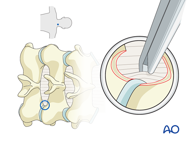 A Kerrison rongeur may be used from medial to lateral to resect exposed ligamentum flavum during Posterior endoscopic cervical foraminotomy (PECF).
