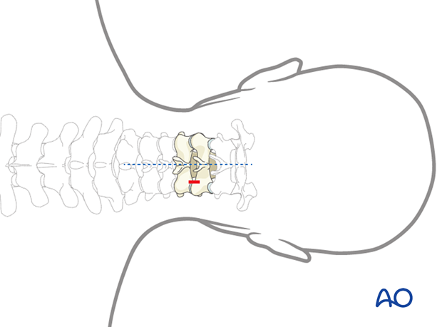 Location of the incision during Posterior endoscopic cervical foraminotomy (PECF).