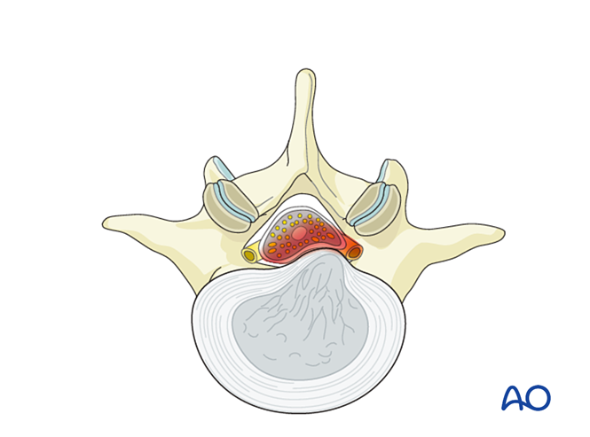 Interlaminar microscopic tubular lumbar discectomy (IMTLD) for Lumbar ...