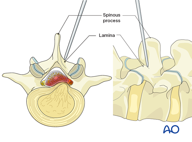 Inserting the first dilator during Interlaminar microscopic tubular lumbar discectomy (IMTLD)