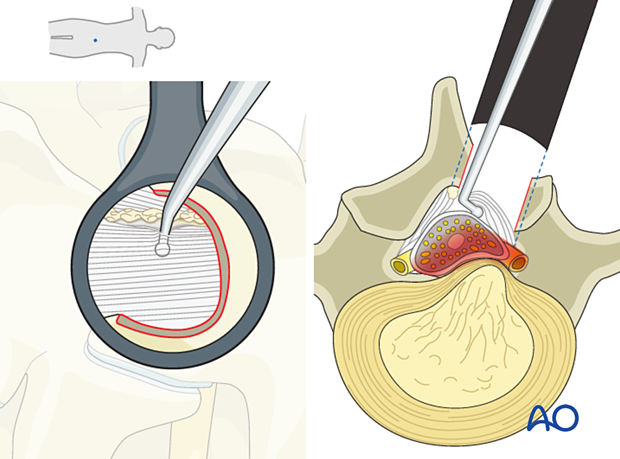 Separating the undersurface of the ligamentum flavum from the dura during minimally invasive surgery on the lumbar spine.