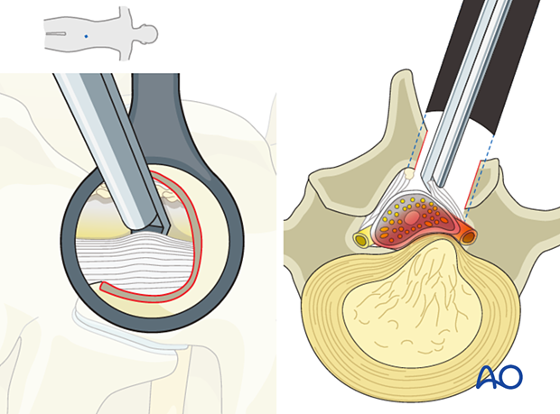 Using a Kerrison rongeur to resect the ipsilateral ligamentum flavum from medial to lateral during an Interlaminar microscopic tubular lumbar discectomy.