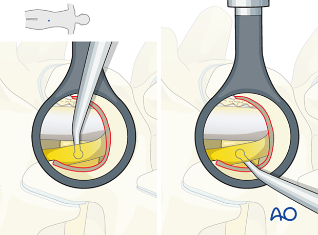 Separating the nerve root from the disc herniation during an Interlaminar microscopic tubular lumbar discectomy.