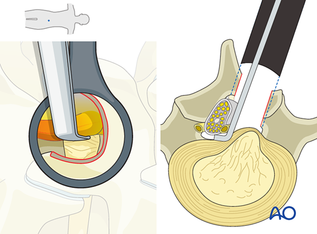 Retracting the nerve root during an Interlaminar microscopic tubular lumbar discectomy.