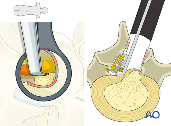 Interlaminar microscopic tubular lumbar discectomy (IMTLD) for Lumbar ...