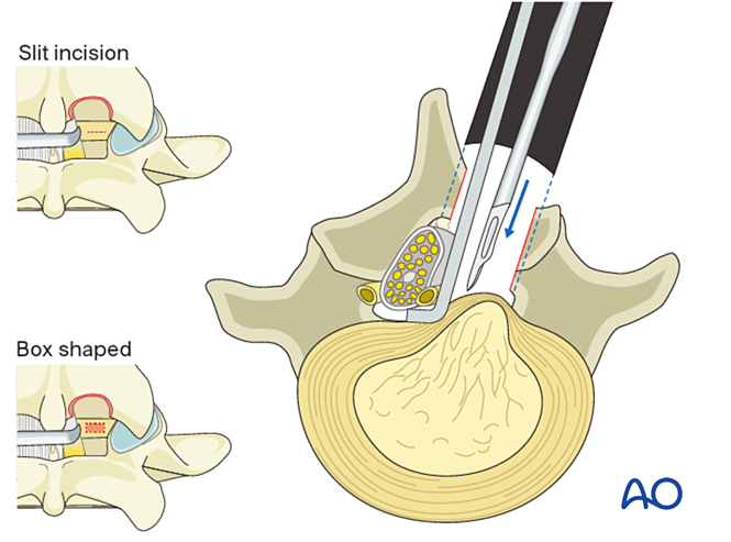 Interlaminar microscopic tubular lumbar discectomy (IMTLD) for Lumbar ...