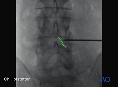 Interlaminar endoscopic lumbar discectomy (IELD) for Lumbar disc ...