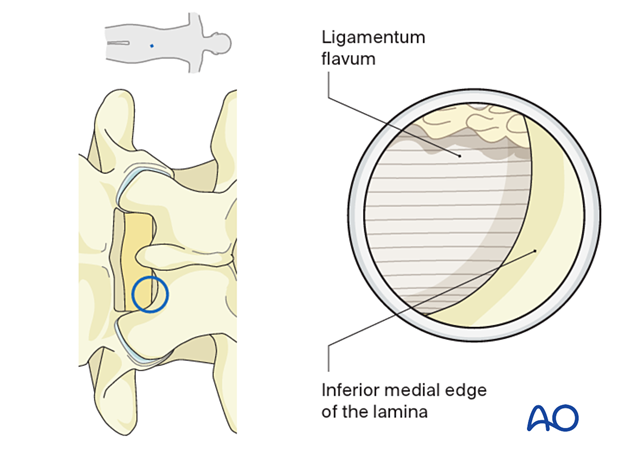 Identifying the ligamentum flavum and the inferior medial edge of the lamina during Interlaminar endoscopic lumbar discectomy (IELD).