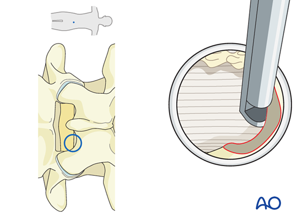 Using Kerrison rongeurs during an Interlaminar endoscopic lumbar discectomy (IELD).