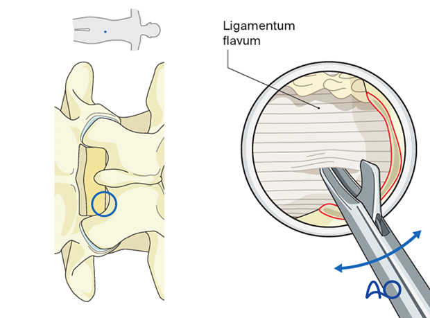 Using a micro-punch to pierce through the ligamentum flavum during an Interlaminar endoscopic lumbar discectomy (IELD).
