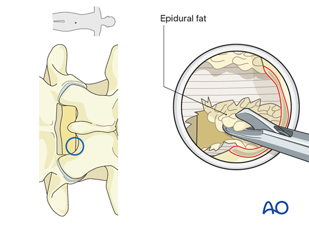 Taking small bites of epidural fat with the micro-punch during an Interlaminar endoscopic lumbar discectomy (IELD).