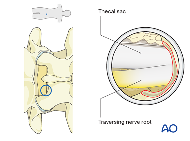 A clear view of the neural elements must be achieved during an Interlaminar endoscopic lumbar discectomy (IELD).