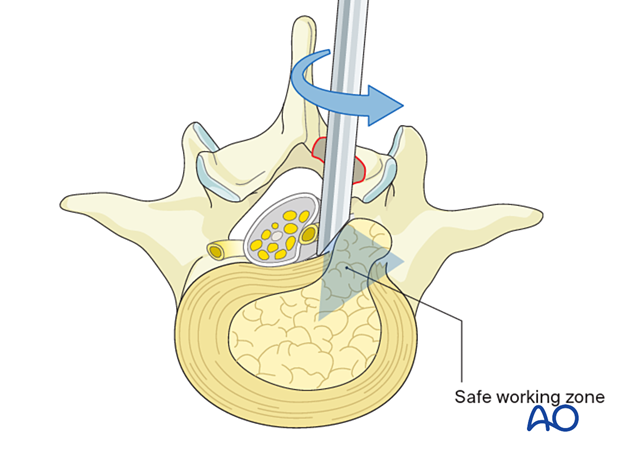 57b P220 Interlaminar endoscopic lumbar discectomy IELD