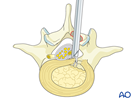 Interlaminar endoscopic lumbar discectomy (IELD)