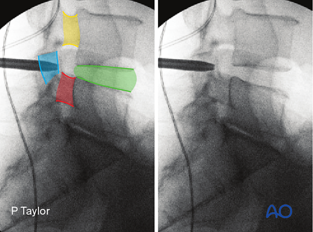 Identifying the caudal pedicle (red), the cranial pedicle (yellow), the disc space (green) and the pars (blue) during Extraforaminal microscopic tubular lumbar discectomy (EMTLD).