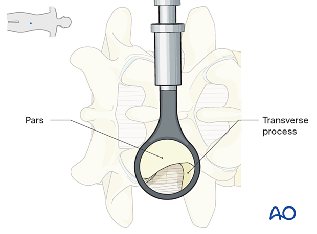 Visualize the inferior edge of the cranial level transverse process and the lateral border of the pars during Extraforaminal microscopic tubular lumbar discectomy (EMTLD).