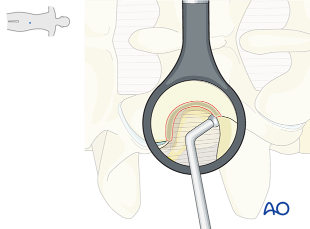 Palpating the smooth, inferior part of the cranial pedicle during Extraforaminal microscopic tubular lumbar discectomy (EMTLD).