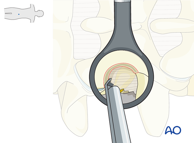 Removing the exposed lateral extent of ligamentum flavum, the intertransverse process ligament, and the soft tissues covering the exiting nerve root during Extraforaminal microscopic tubular lumbar discectomy (EMTLD).
